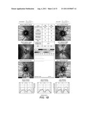 GLAUCOMA COMBINATORIAL ANALYSIS diagram and image