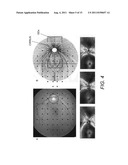 GLAUCOMA COMBINATORIAL ANALYSIS diagram and image