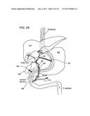 RAPID EXCHANGE FNA BIOPSY DEVICE WITH DIAGNOSTIC AND THERAPEUTIC     CAPABILITIES diagram and image