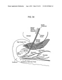 RAPID EXCHANGE FNA BIOPSY DEVICE WITH DIAGNOSTIC AND THERAPEUTIC     CAPABILITIES diagram and image