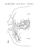 VASCULAR INTRODUCERS HAVING AN EXPANDABLE SECTION diagram and image