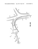 VASCULAR INTRODUCERS HAVING AN EXPANDABLE SECTION diagram and image