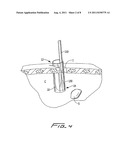 SURGICAL RETRIEVAL APPARATUS diagram and image