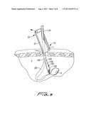 SURGICAL RETRIEVAL APPARATUS diagram and image