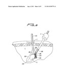 SURGICAL RETRIEVAL APPARATUS diagram and image