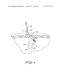 SURGICAL RETRIEVAL APPARATUS diagram and image