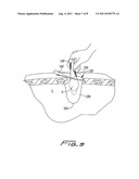 SURGICAL RETRIEVAL APPARATUS diagram and image