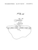 SURGICAL RETRIEVAL APPARATUS diagram and image