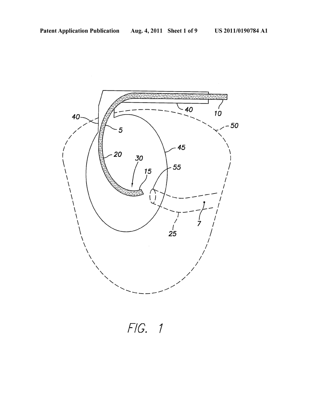 CATHETER WITH REMOVABLE SHAPING SKELETON AND METHODS OF USING AND MAKING     SAME - diagram, schematic, and image 02