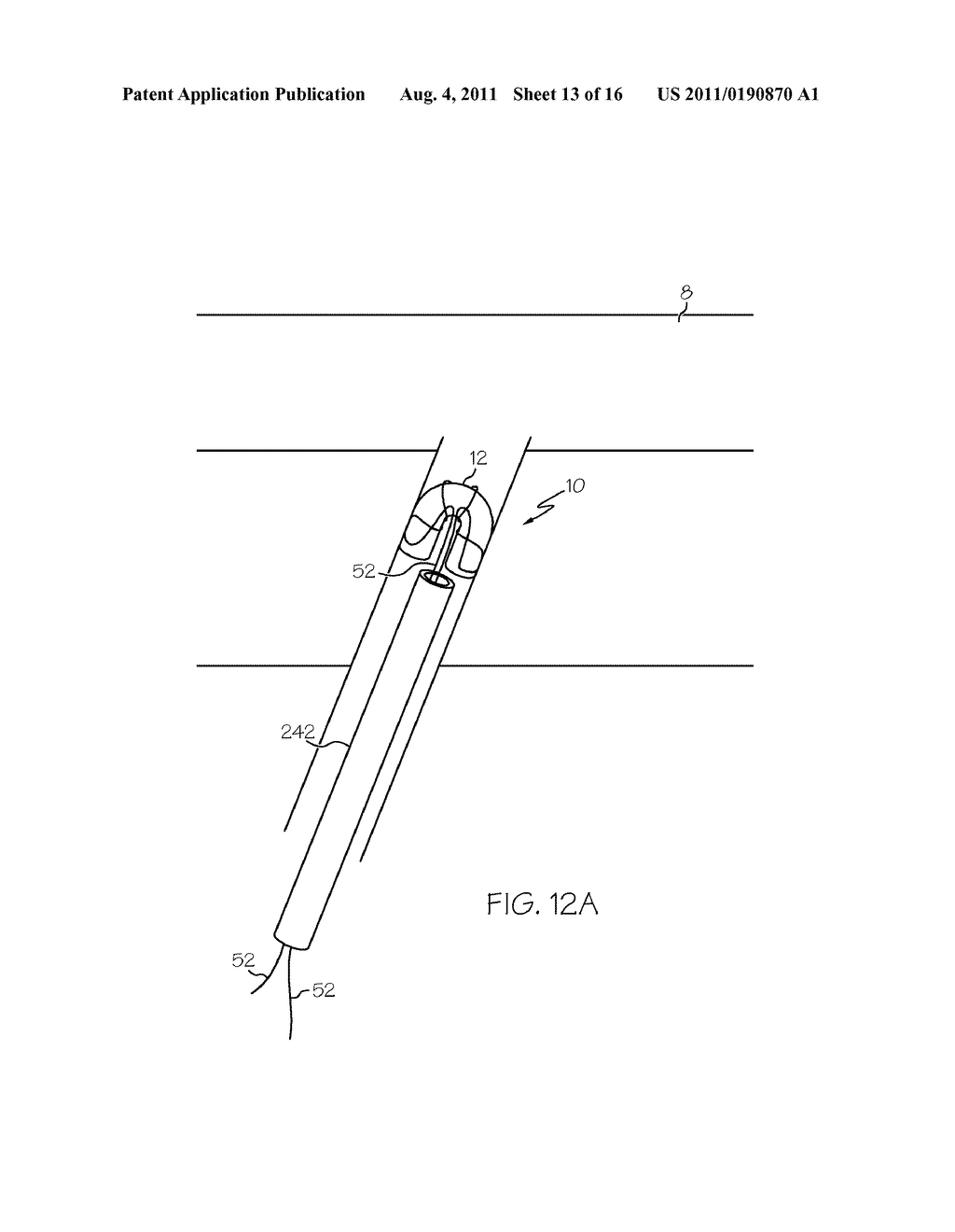 Covered Stent for Vascular Closure - diagram, schematic, and image 14