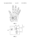 SURGICAL TECHNIQUE USING A CONTOURED ALLOGRAFT CARTILAGE AS A SPACER OF     THE CARPO-METACARPAL JOINT OF THE THUMB OR CARPO-METATARSAL JOINT OF THE     TOE diagram and image