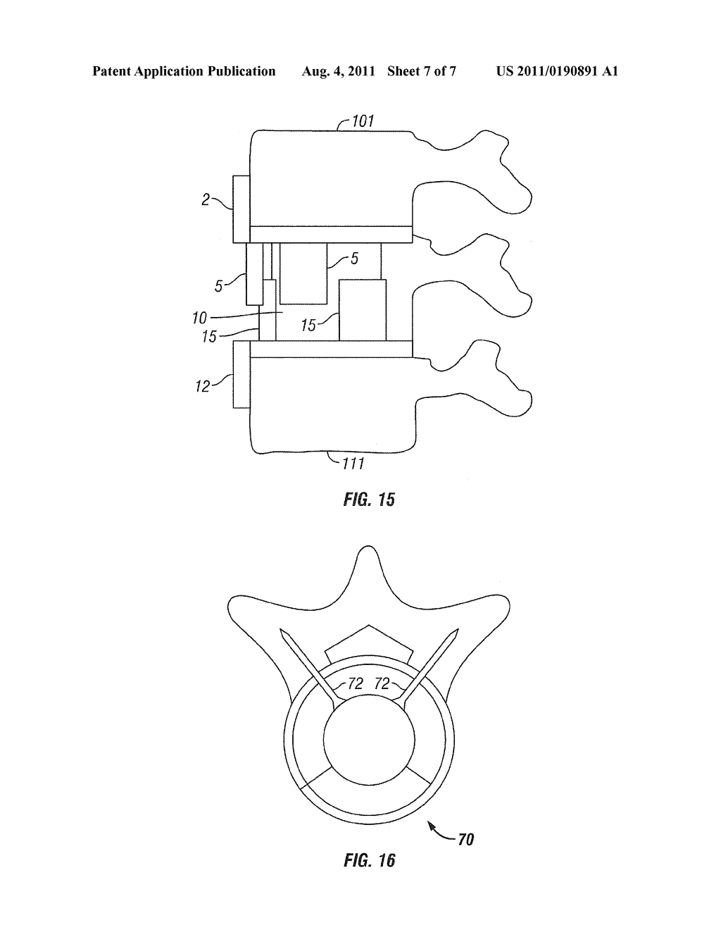Device for Stabilizing a Vertebral Joint and Method for Anterior Insertion     Thereof - diagram, schematic, and image 08