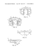 CRUCIATE-RETAINING KNEE PROSTHESIS diagram and image