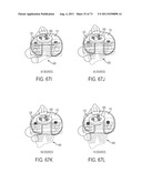 CRUCIATE-RETAINING KNEE PROSTHESIS diagram and image