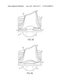 CRUCIATE-RETAINING KNEE PROSTHESIS diagram and image