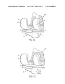 CRUCIATE-RETAINING KNEE PROSTHESIS diagram and image