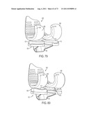 CRUCIATE-RETAINING KNEE PROSTHESIS diagram and image