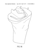 CRUCIATE-RETAINING KNEE PROSTHESIS diagram and image