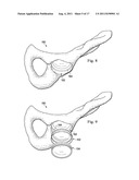 Acetabular Prosthetic Devices and Associated Methods diagram and image