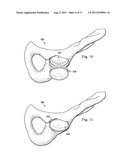 Acetabular Prosthetic Devices and Associated Methods diagram and image