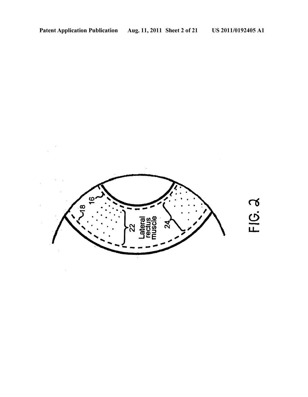 METHODS FOR TREATING EYE CONDITIONS - diagram, schematic, and image 03