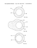 Use of Micro-Electro-Mechanical Systems (MEMS) in Well Treatments diagram and image