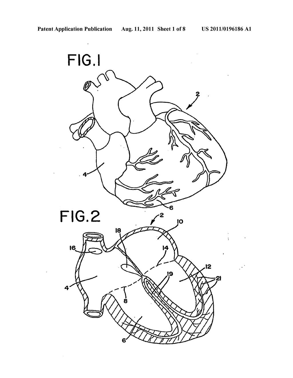 METHODS AND APPARATUS EMPLOYING IONIZING RADIATION FOR TREATMENT OF     CARDIAC ARRHYTHMIA - diagram, schematic, and image 02