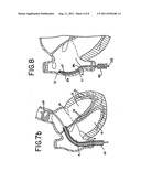 METHODS AND APPARATUS EMPLOYING IONIZING RADIATION FOR TREATMENT OF     CARDIAC ARRHYTHMIA diagram and image