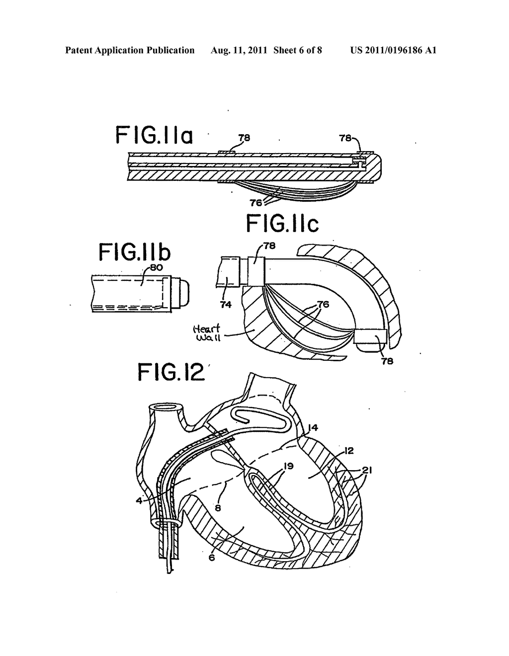 METHODS AND APPARATUS EMPLOYING IONIZING RADIATION FOR TREATMENT OF     CARDIAC ARRHYTHMIA - diagram, schematic, and image 07