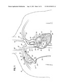 CANNULA LINED WITH TISSUE IN-GROWTH MATERIAL AND METHOD OF USING THE SAME diagram and image