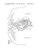 CANNULA LINED WITH TISSUE IN-GROWTH MATERIAL AND METHOD OF USING THE SAME diagram and image