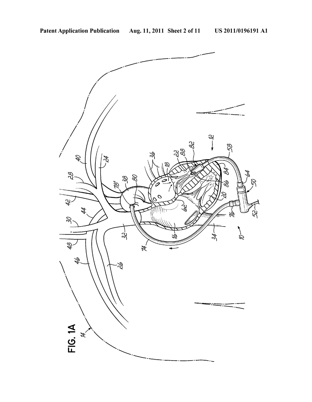 CANNULA LINED WITH TISSUE IN-GROWTH MATERIAL AND METHOD OF USING THE SAME - diagram, schematic, and image 03