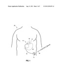 IMPLANTABLE SUBCUTANEOUS ACCESS PORT diagram and image