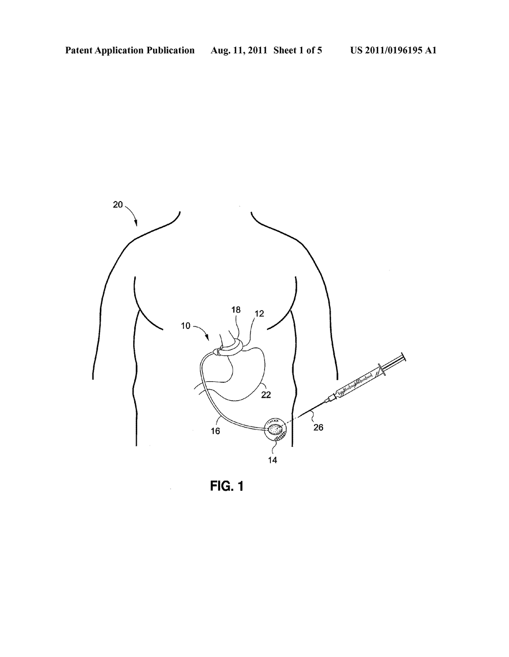 IMPLANTABLE SUBCUTANEOUS ACCESS PORT - diagram, schematic, and image 02