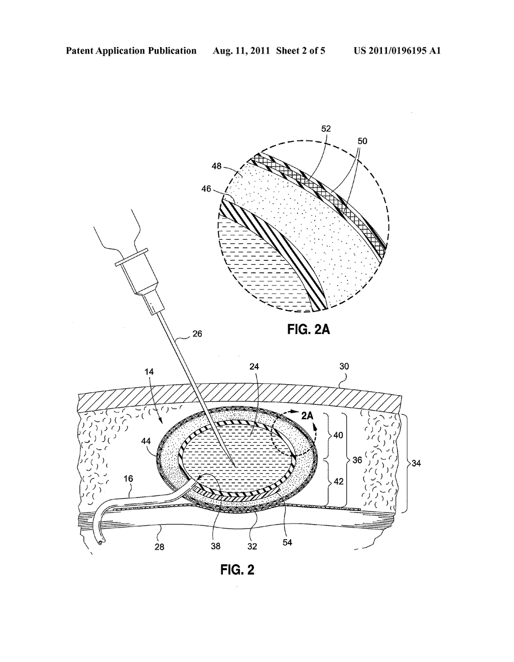 IMPLANTABLE SUBCUTANEOUS ACCESS PORT - diagram, schematic, and image 03