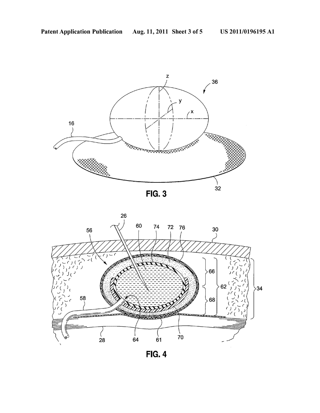 IMPLANTABLE SUBCUTANEOUS ACCESS PORT - diagram, schematic, and image 04