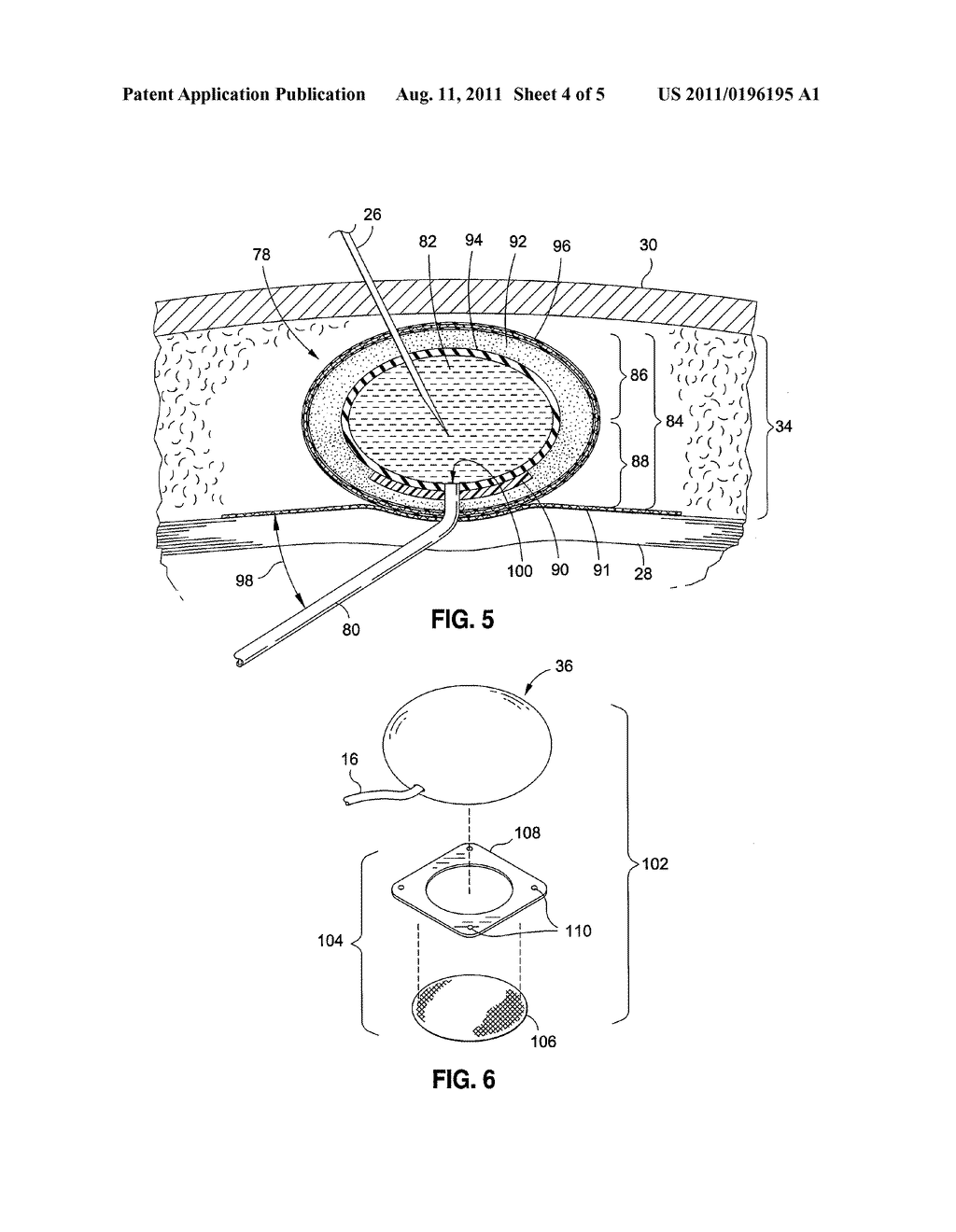 IMPLANTABLE SUBCUTANEOUS ACCESS PORT - diagram, schematic, and image 05