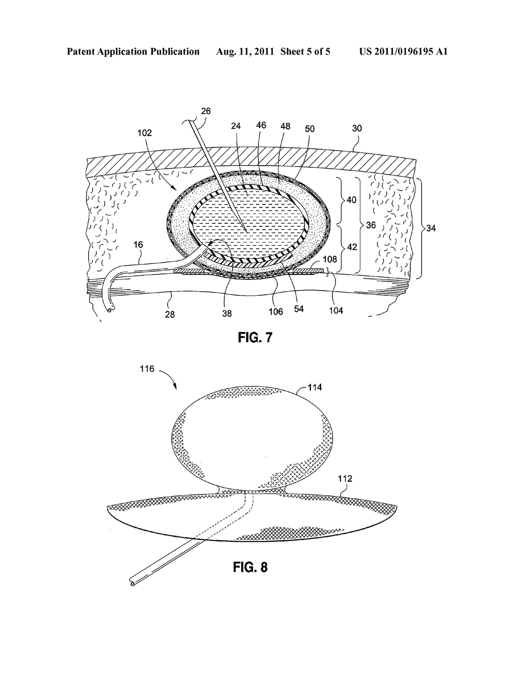 IMPLANTABLE SUBCUTANEOUS ACCESS PORT - diagram, schematic, and image 06