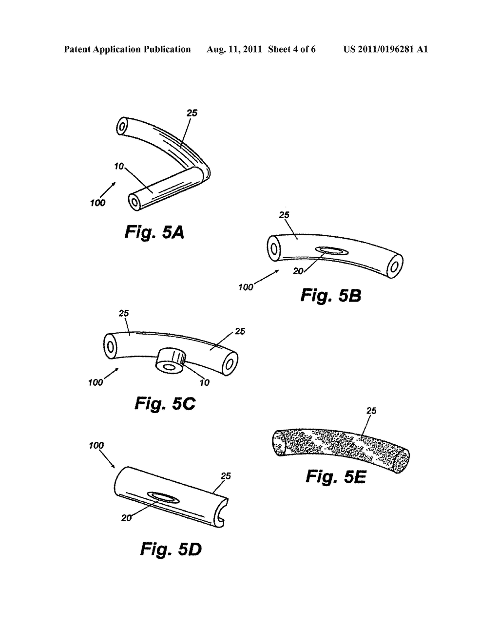 SHUNT DEVICE AND METHOD FOR TREATING OCULAR DISORDERS - diagram, schematic, and image 05