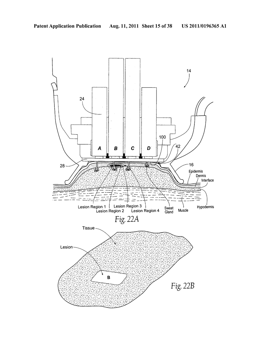 Systems, Apparatus, Methods, and Procedures for the Non-Invasive Treatment     of Tissue Using Microwave Energy - diagram, schematic, and image 16