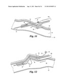 VASCULAR SUTURING DEVICE diagram and image