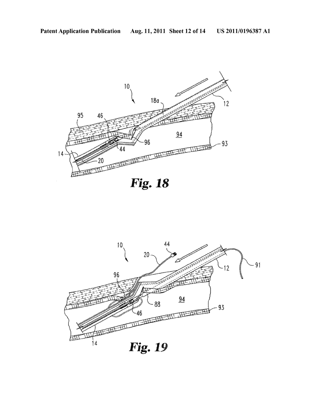 VASCULAR SUTURING DEVICE - diagram, schematic, and image 13