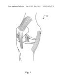 METHOD AND SYSTEM FOR COMPRESSION AND FIXATION OF TENDON TO BONE diagram and image