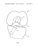 METHOD AND SYSTEM FOR COMPRESSION AND FIXATION OF TENDON TO BONE diagram and image