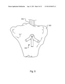 METHOD AND SYSTEM FOR COMPRESSION AND FIXATION OF TENDON TO BONE diagram and image