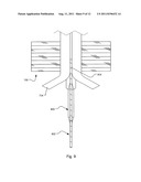 METHOD AND SYSTEM FOR COMPRESSION AND FIXATION OF TENDON TO BONE diagram and image