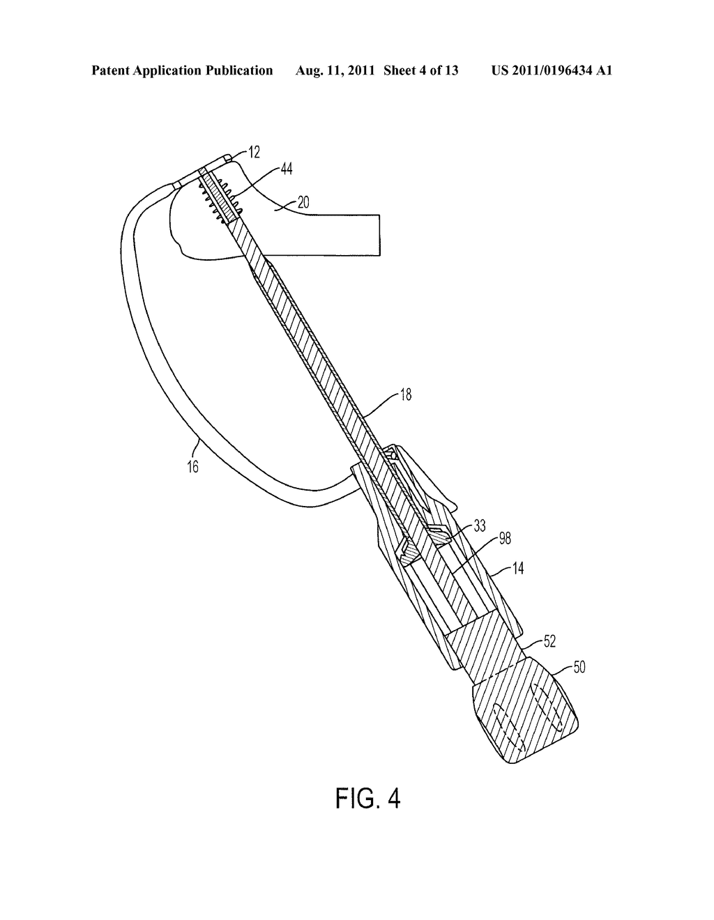 SYSTEM AND METHOD FOR RETROGRADE PROCEDURE - diagram, schematic, and image 05