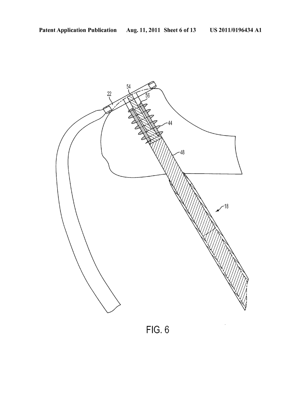 SYSTEM AND METHOD FOR RETROGRADE PROCEDURE - diagram, schematic, and image 07