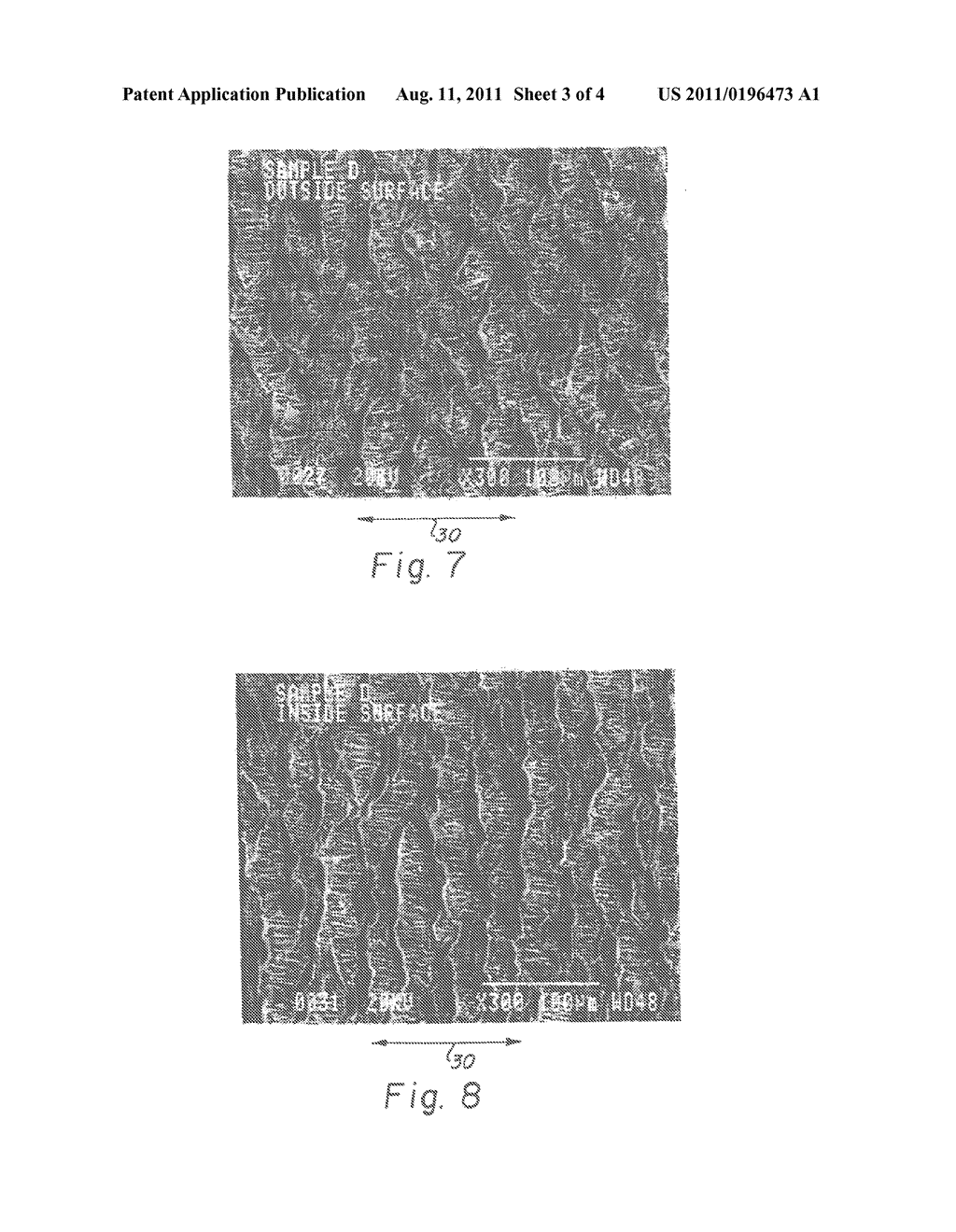 METHODS FOR MAKING AN ENCAPSULATED STENT AND INTRALUMINAL DELIVERY THEREOF - diagram, schematic, and image 04