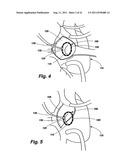 POST-OPERATIVE ADJUSTMENT TOOL, MINIMALLY INVASIVE ATTACHMENT APPARATUS,     AND ADJUSTABLE TRICUSPID RING diagram and image